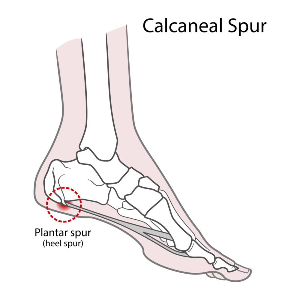 Healing the Pain of Heel Spurs